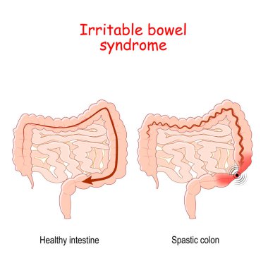 Sinirli bağırsak sendromu işlevsel bir gastrointestinal bozukluktur. Vektör illüstrasyonu