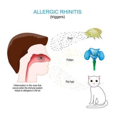 Alerjik rhinitis. Burun iltihabı, bağışıklık sisteminin havadaki alerjilere tepki vermesiyle oluşur. Toz, polen ve evcil hayvan kılı. İnsan burnunun kesiti.