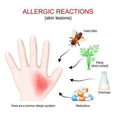 Alerjik reaksiyon ve deri lezyonları. Deri döküntüsü ya da ürtizi olan insan eli. Alerjiye sebep olan alerjiler: ilaçlar, kimyasallar, bitkilerle doğrudan temas, böcek ısırıkları veya arı sokmaları. Kurdeşen yaygın bir alerjik semptomdur. Vektör posteri