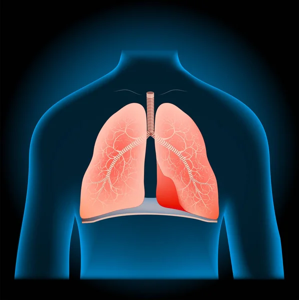 X線青の現実的な胴に肺やダイヤフラム 暗い背景に人間のシルエット 呼吸器系の一部 ベクターポスター — ストックベクタ