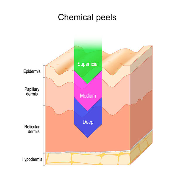 Chemical peel, a treatment that uses a chemical solution to remove the outer layer of dead skin. Skin layers: Reticular dermis, Papillary dermis, Epidermis. depth of Peeling penetration. Vector poster