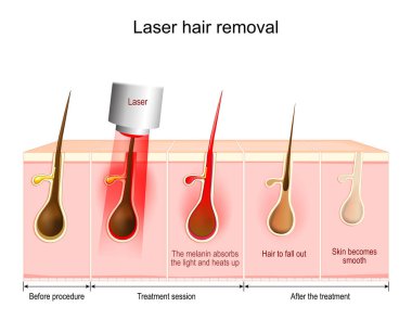 Lazer tüy aldırma. Melanin ışığı emer ve ısınır, saçlar dökülür. İşlemden önce, tedaviden sonra ve tedavi sırasında cilt ve saç durumu hakkında vektör diyagramı.