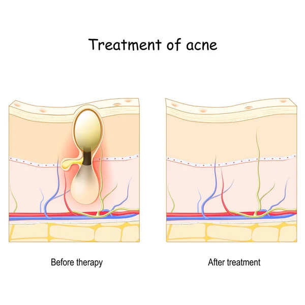 Acné Tratamiento Antes Después Terapia Corte Transversal Piel Póster Vector — Vector de stock