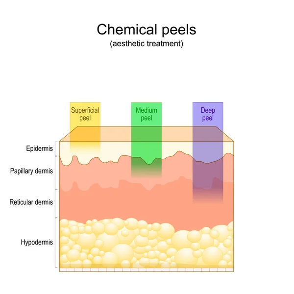 Schönheitsbehandlung Chemische Peelings Tiefe Mittlere Oberflächliche Schale Querschnitt Durch Schichten — Stockvektor