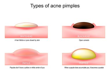 Types of acne pimples. Vector illustration clipart