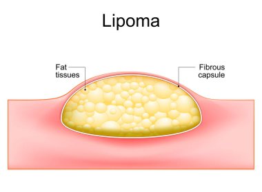 Lipoma. Derideki deri altı dokularında bulunan adipoz tümörleri. İnsan derisinin çapraz kesimi. Vektör illüstrasyonu.