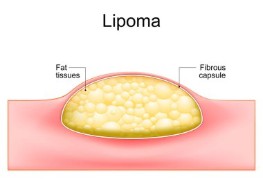 Lipoma. adipose tumors located into the subcutaneous tissues in the skin. Cross section of a human skin. Vector illustration. clipart