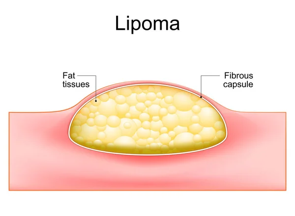 Lipoma Tumeurs Adipeuses Situées Dans Les Tissus Sous Cutanés Peau — Image vectorielle