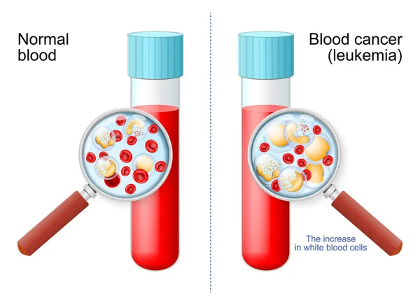 白血病 放大镜下试管中的红白血球 健康血液与血癌的比较和差异 红细胞 单核细胞 基底细胞 嗜酸性粒细胞 中性粒细胞 淋巴细胞的特写 — 图库矢量图片