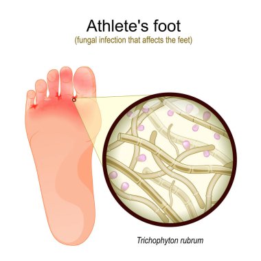 Athlete's foot is a fungal infection that affects the feet. sole of foot with parasitic fungus. Close-up of  Trichophyton rubrum Fertile Hyphae, Macroconidia and Microconidia. Vector illustration clipart