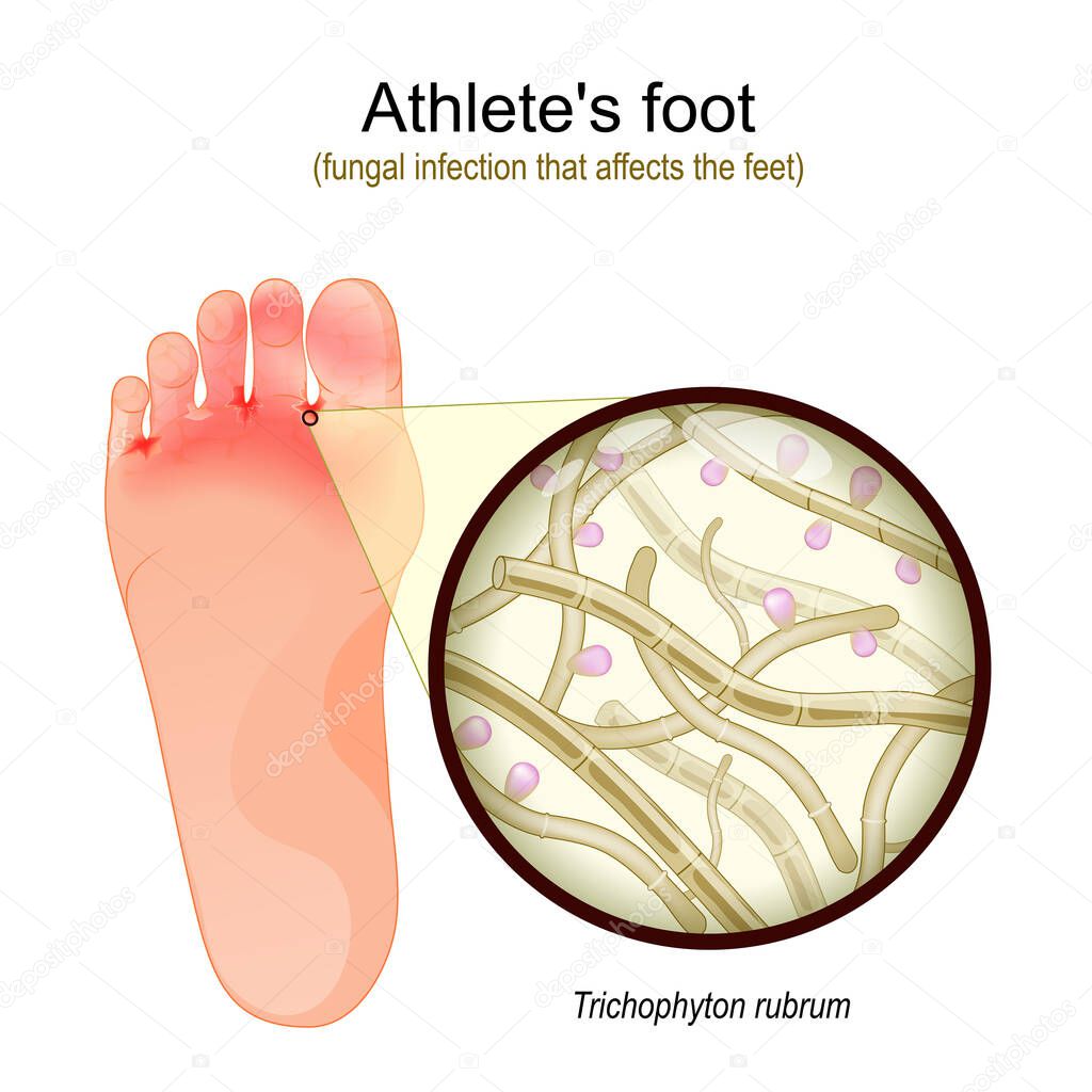 Athlete's foot is a fungal infection that affects the feet. sole of foot with parasitic fungus. Close-up of  Trichophyton rubrum Fertile Hyphae, Macroconidia and Microconidia. Vector illustration