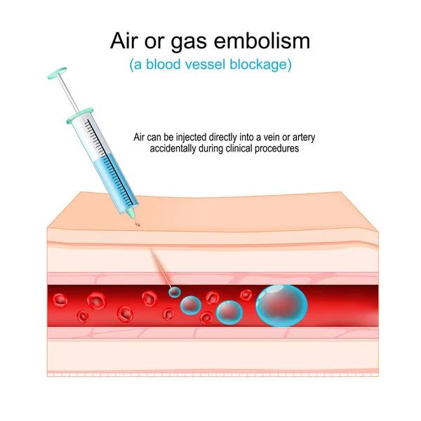 空气或气体栓塞 血管阻塞 在临床过程中不小心直接注入静脉或动脉的空气 人的皮肤 注射器 有红血球和气泡的血管 矢量说明 — 图库矢量图片