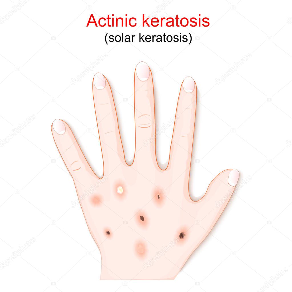 Actinic keratosis are dry scaly patches of skin that have been damaged by the sun. humans hand with solar keratosis. vector illustration