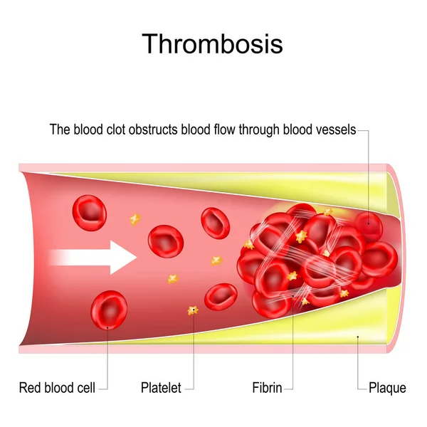 Thrombose Caillot Sang Obstrue Flux Sanguin Travers Les Vaisseaux Sanguins — Image vectorielle