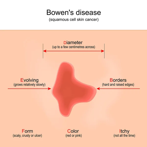 Doença Bowen Cancro Pele Células Escamosas Sinais Sintomas Infográfico Cartaz — Vetor de Stock