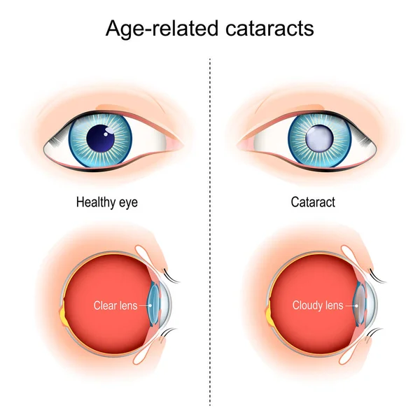 Cataratta Problemi Vista Legati All Età Vista Trasversale Che Mostra — Vettoriale Stock