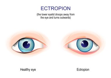 Ektropion. Göz kapağının alt kısmı dışa doğru sarkıyor. Tıbbi muayene. vektör illüstrasyonu