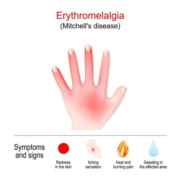 Erythromelalgia Rare Condition Causes Episodes Burning Pain Redness Hands Other — стоковый вектор