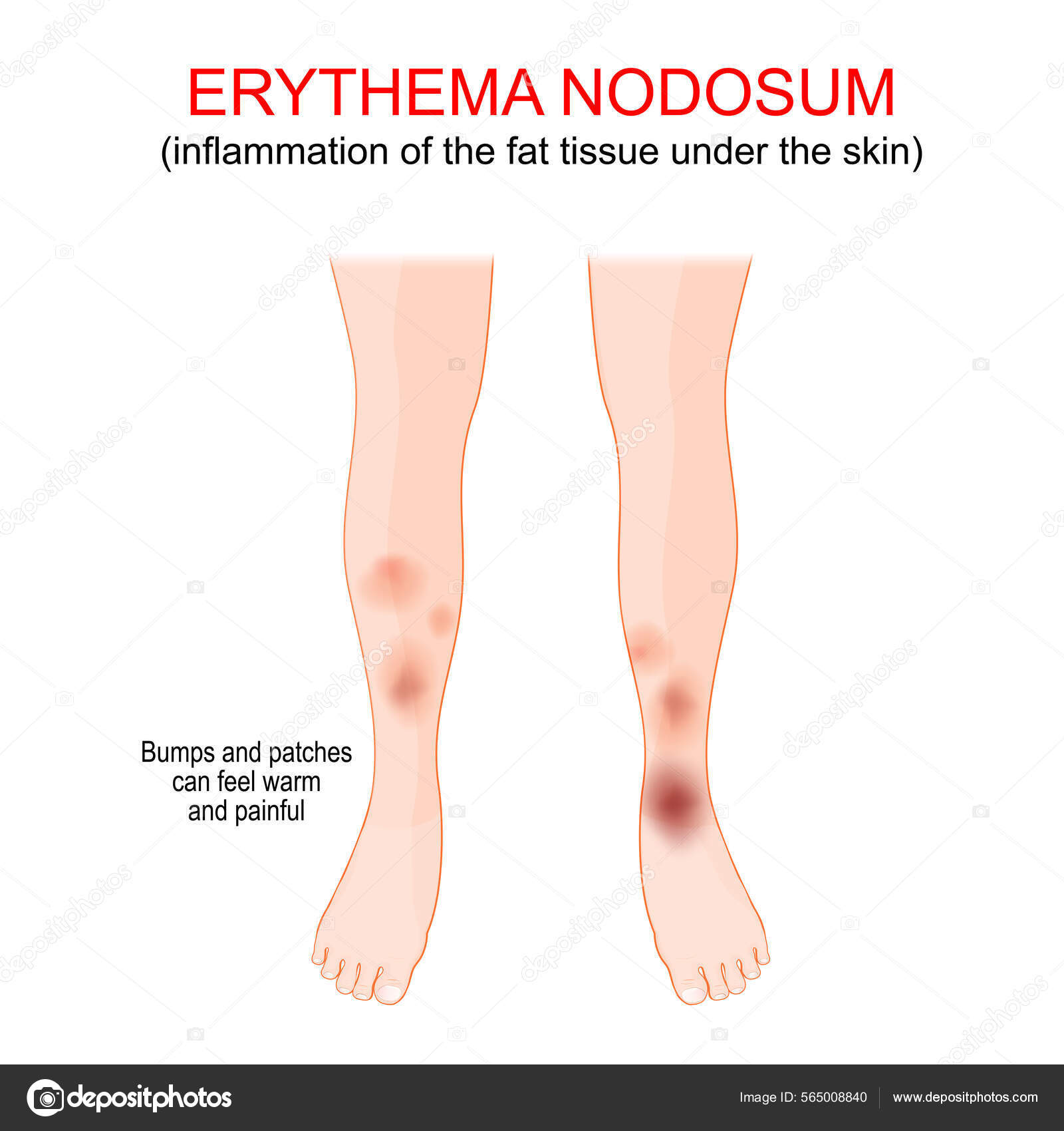 Image vectorielle Erythème Nodosum Inflammation Tissu Adipeux Sous ...