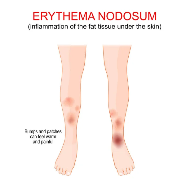 Erythema Nodosum Inflammation Fat Tissue Skin Bumps Patches Feel Warm — Vector de stock