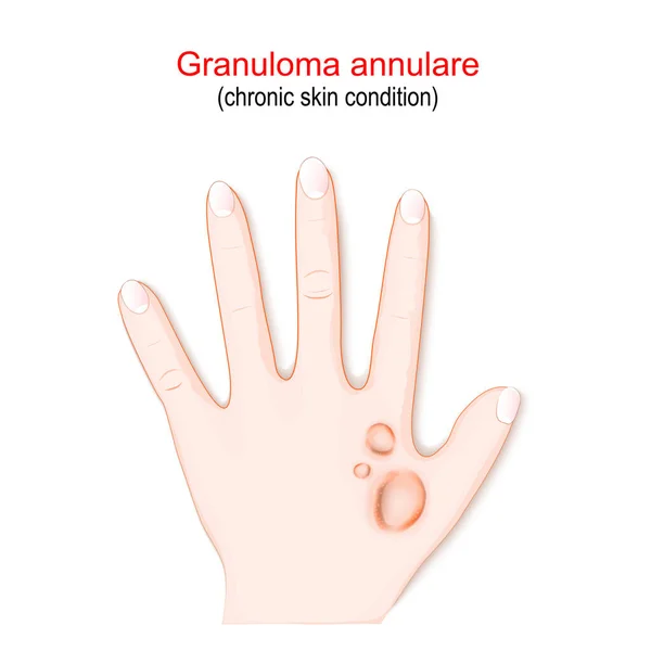 Granuloma Annulare Chronic Skin Condition Hand Reddish Bumps Skin Arranged — 스톡 벡터