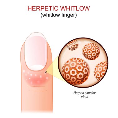 Herpetik whitlow. Beyazparmak. Deri hastalığı olan insan parmağı. Herpes Simplex virüsünün yakın plan görüntüsü. vektör illüstrasyonu