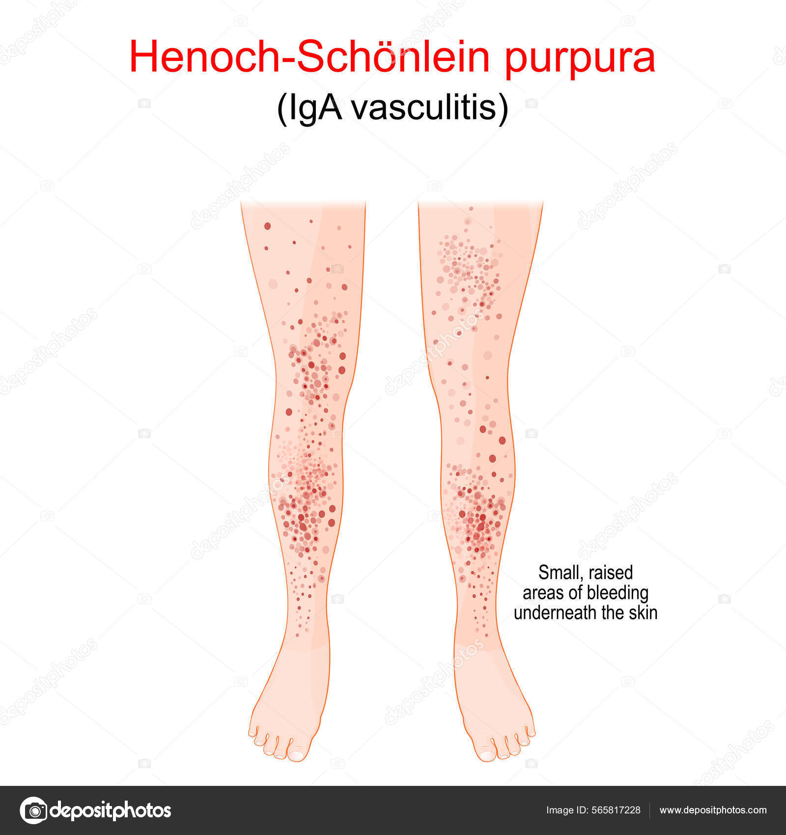 Filaríase Linfática (Elefantíase) | Concise Medical Knowledge, image size:1600x1700