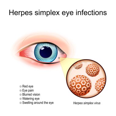 Herpes simplex göz enfeksiyonları. Etrafında şişlik olan kırmızı bir insan gözü. Herpes Simplex virüsüne yakın çekim. Virions göz enfeksiyonuna neden oldu. vektör illüstrasyonu