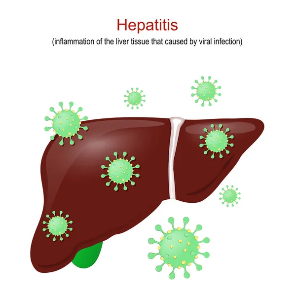 Hepatitis Inflammation Liver Tissue Caused Viral Infection Human Liver Virions — Stock Vector