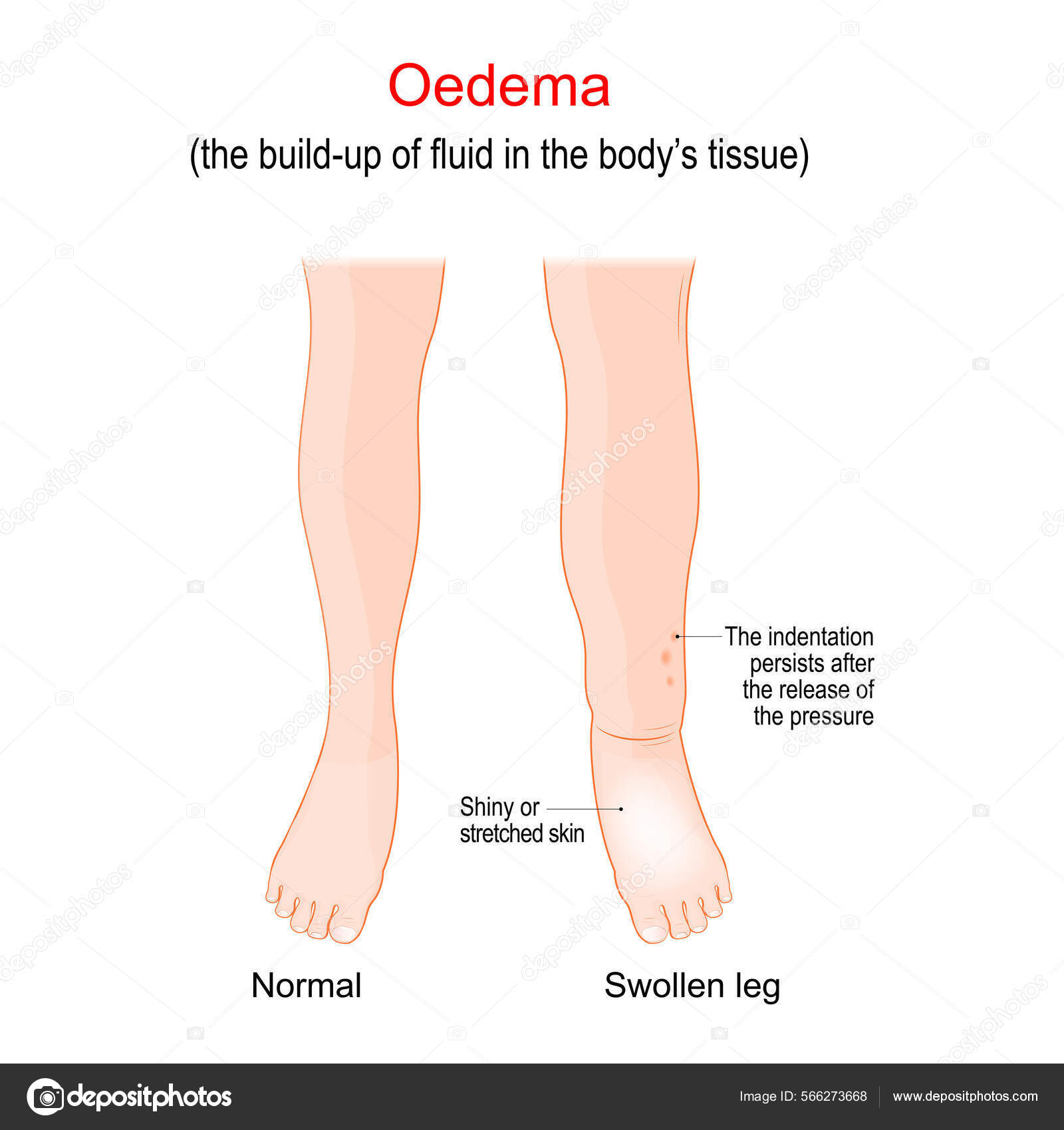 Edema Swollen Ankles Feet Legs Oedema Build Fluid Body's Tissue image