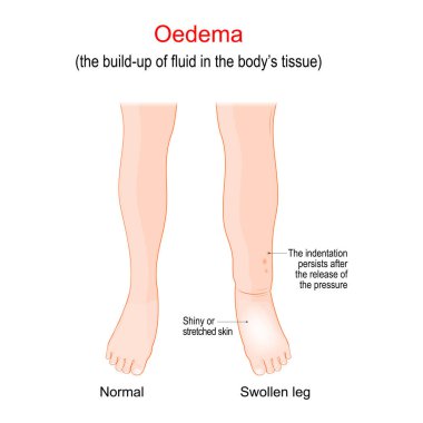 Edema. Swollen ankles, feet and legs. oedema is the build-up of fluid in the body's tissue. Vector illustration. Poster for medical use clipart