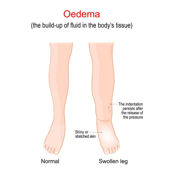 Edema 挥动脚踝 脚和腿 水肿是身体组织中液体的堆积 矢量图解 医疗用海报 — 图库矢量图片