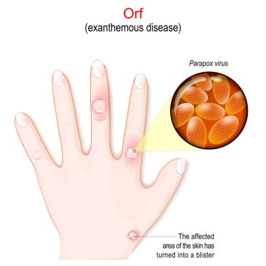 Orf. exanthemous disease. Humans hand with The affected area of the skin that has turned into a blister. Close-up of virions of parapox virus that caused infection disease. Vector illustration