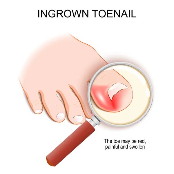 Ingrown Toenail Top View Magnifying Glass Foot Nail Grows Toe — Stock Vector