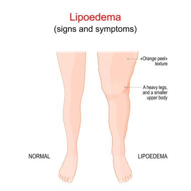 Lipoödem ya da Lipedema. Bacaklarda anormal yağ birikimi. Farklılık ve karşılaştırma normal sağlıklı bacak ve etkilenmiş bacak ile cilt 