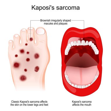 Kaposi sarkomu, insan herpesvirüsünün yol açtığı nadir görülen bir kanser türüdür. Kaposi 'nin sarkomu ağız ve ayağı etkiler. Kaposi 'nin sarkomu belirtileri kırmızı ya da çürüğe benzeyen mor deri lezyonları. vektör