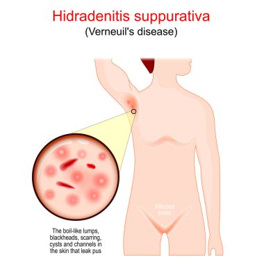 Hidradenitis suppurativa. acne inversa is a painful skin condition that causes abscesses and scarring on the skin. affected areas of Verneuil's disease. Vector poster clipart