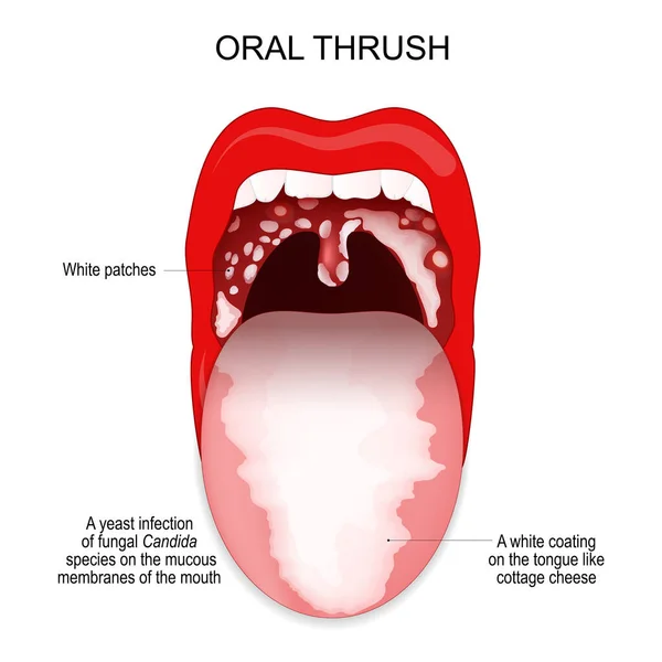 Oral Thrush Yeast Infection Fungal Candida Species Mucous Membranes Mouth — Stock Vector