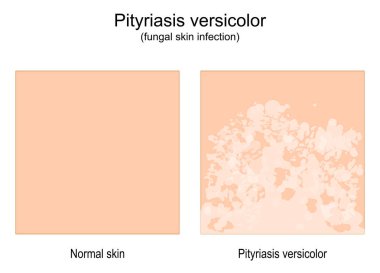 Pityriasis versicolor. Mantar derisi enfeksiyonu. sağlıklı cilt ve tinea versicolor karşılaştırması. Vektör illüstrasyonu