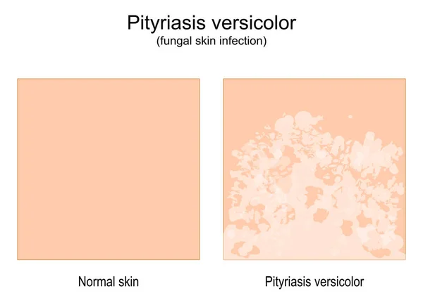 Pityriasis Versicolor Plísňová Kožní Infekce Srovnání Zdravé Kůže Tinea Versicolor — Stockový vektor