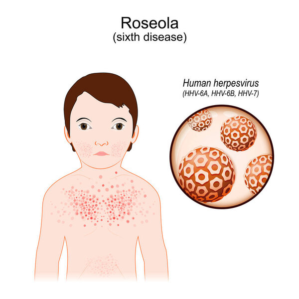 Roseola. Signs and symptoms of ill. child with rash of sixth disease. infectious disease. Close-up of human herpes viruses. Vector illustration