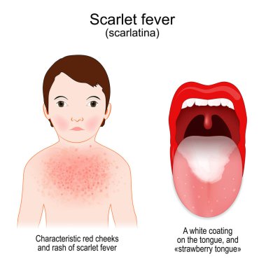 Scarlet fever. Signs and symptoms of Scarlatina. child with rash and Characteristic red cheeks. infectious disease. mouth and throat of a child with a streptococcal pharyngitis. A white coating on the tongue. strawberry tongue. Vector illustration clipart