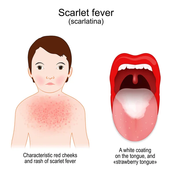 Scarlet Fever Signs Symptoms Scarlatina Child Rash Characteristic Red Cheeks — Stock Vector
