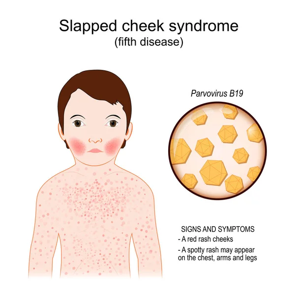 Ötödik Betegség Jelek Tünetek Gyereknek Pofon Szindrómája Van Fertőző Betegség — Stock Vector