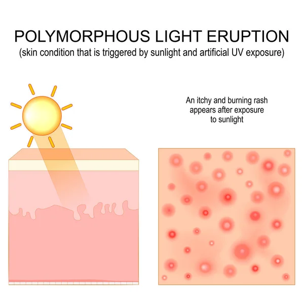 Polymorphic Light Eruption Itchy Burning Rash Appears Exposure Sunlight Close — Stock Vector