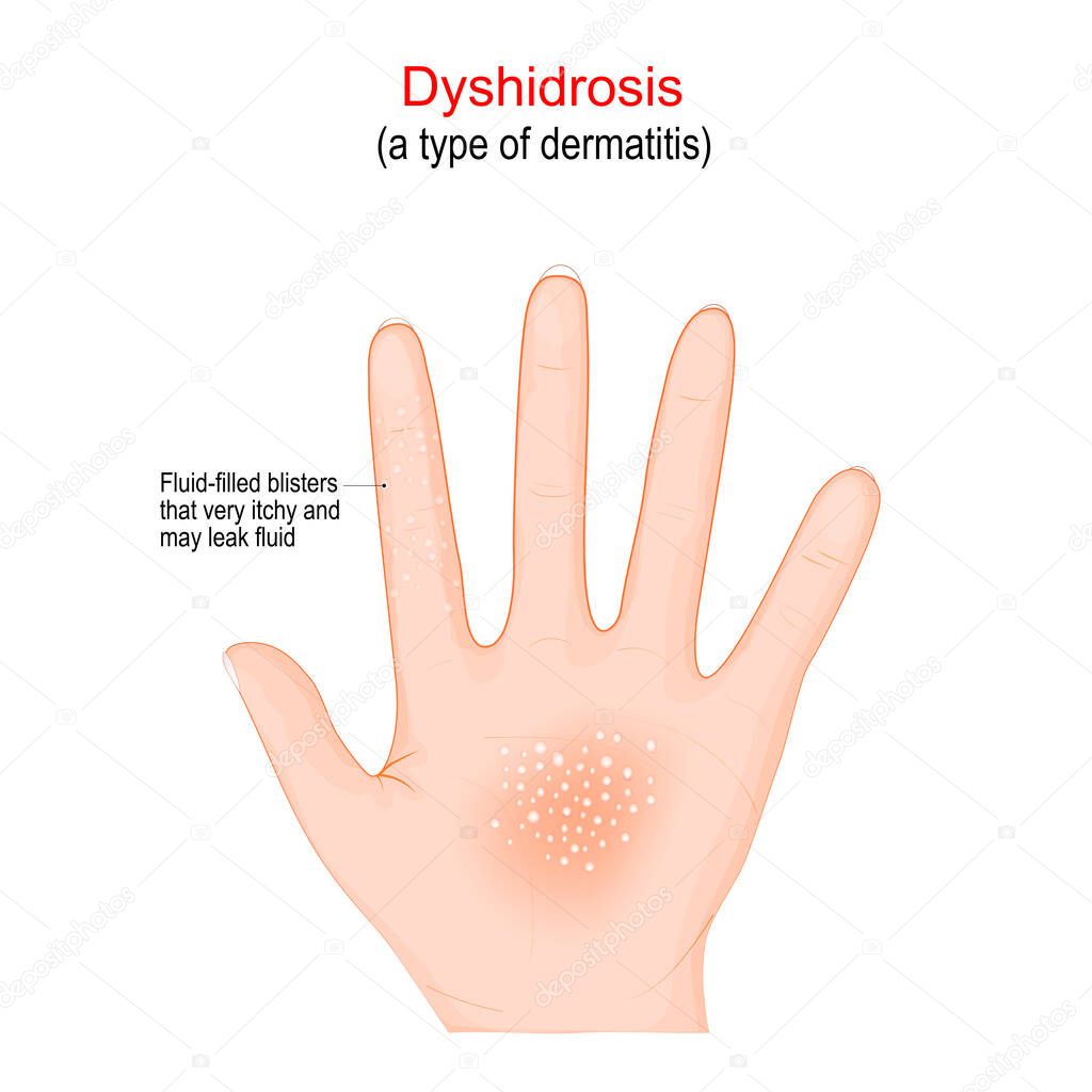 Dyshidrosis. type of dermatitis with itchy blisters on the palms of the hands. Fluid-filled blisters very itchy. Vector illustration