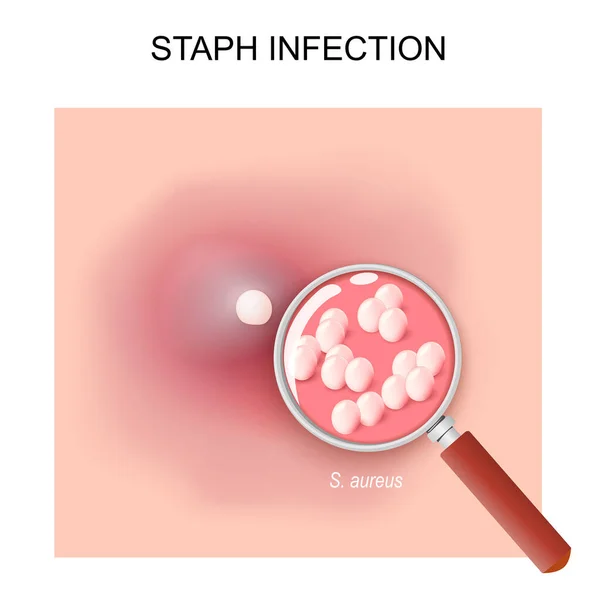 Staph Infection Caused Staphylococcus Bacteria Close Painful Red Bump Skin — Vetor de Stock