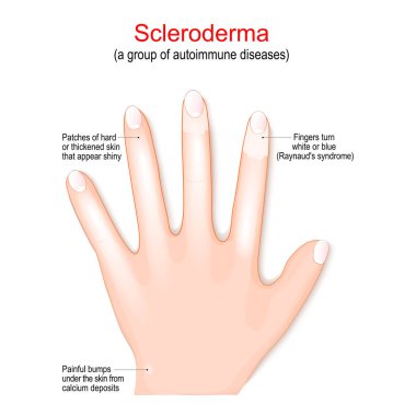 Scleroderma is a group of autoimmune diseases. Signs and symptoms. close-up of a Human's hand with white Fingers (Raynaud's syndrome), Patches of hard or thickened skin that appear shiny. Vector illustration clipart