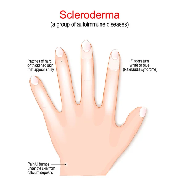Склеродермия Группа Аутоиммунных Заболеваний Признаки Симптомы Крупным Планом Руки Человека — стоковый вектор
