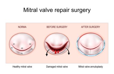 Mitral kapak onarımı ameliyatı. Sağlıklı mitral kapakçık. Yıllık ameliyattan önce ve sonra mitral kapakçık zarar görmüş. vektör illüstrasyonu